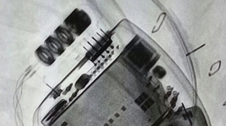 Imatge radiològica del desfibril·lador implantat